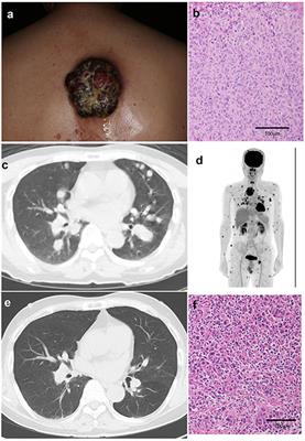 Successful Treatment of Unresectable Advanced Melanoma by Administration of Nivolumab With Ipilimumab Before Primary Tumor Resection